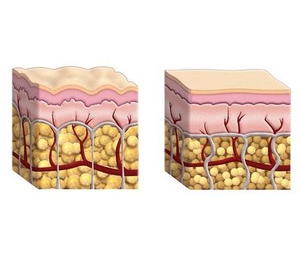 como se forma celulitis