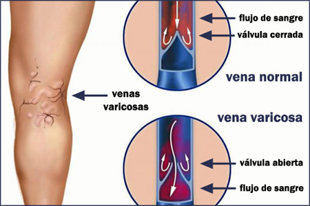 Dibujo esquema varices