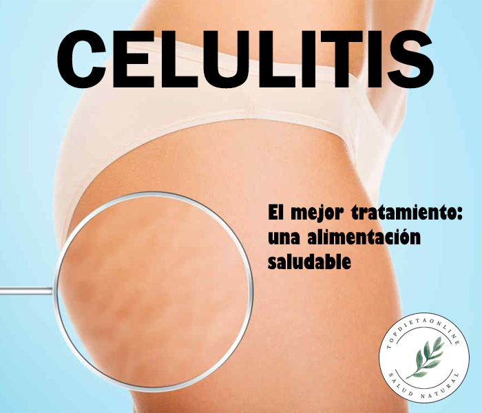 Celulitis
